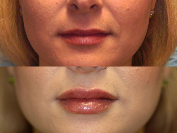 Dermal Fillers & Injectables Before and After Pictures Savannah, GA