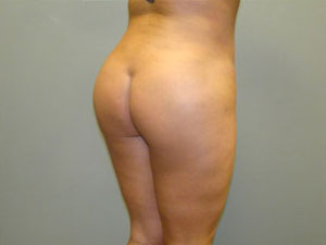 Brazilian Butt Lift Before and After Pictures Savannah, GA