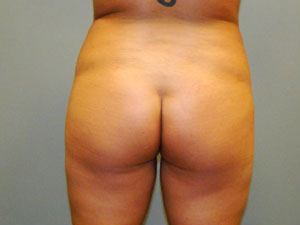 Brazilian Butt Lift Before and After Pictures Savannah, GA