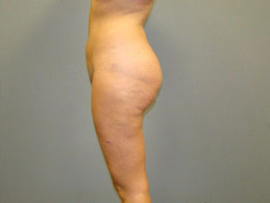 Brazilian Butt Lift Before and After Pictures Savannah, GA