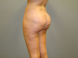 Brazilian Butt Lift Before and After Pictures Savannah, GA