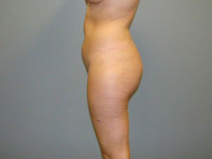 Brazilian Butt Lift Before and After Pictures Savannah, GA