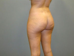 Brazilian Butt Lift Before and After Pictures Savannah, GA