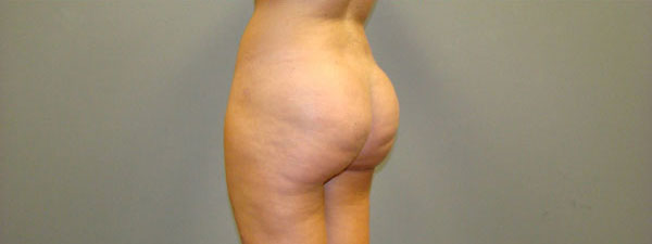 Brazilian Butt Lift Before and After Pictures Savannah, GA