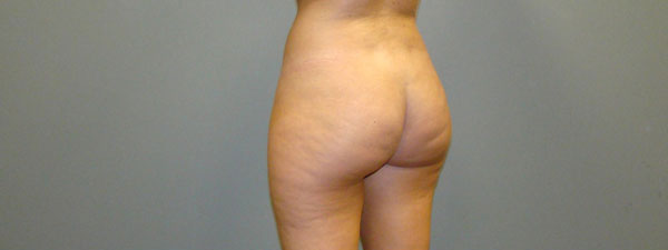 Brazilian Butt Lift Before and After Pictures Savannah, GA