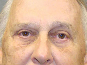 Eyelid Surgery Before and After Pictures Savannah, GA