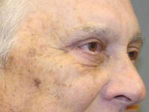 Eyelid Surgery Before and After Pictures Savannah, GA