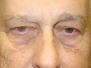 Eyelid Surgery Before and After Pictures Savannah, GA