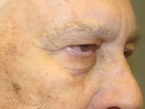 Eyelid Surgery Before and After Pictures Savannah, GA