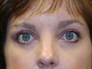 Eyelid Surgery Before and After Pictures Savannah, GA
