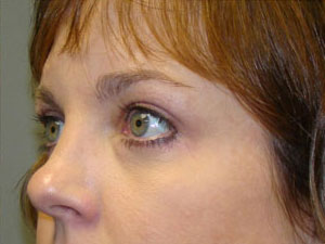 Eyelid Surgery Before and After Pictures Savannah, GA