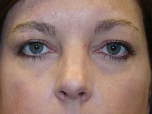 Eyelid Surgery Before and After Pictures Savannah, GA