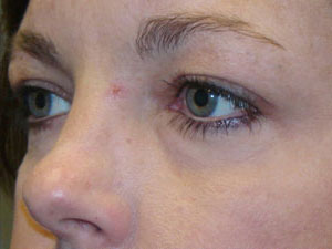 Eyelid Surgery Before and After Pictures Savannah, GA