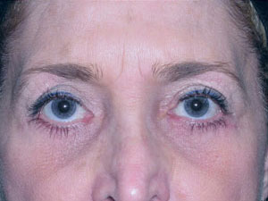Eyelid Surgery Before and After Pictures Savannah, GA
