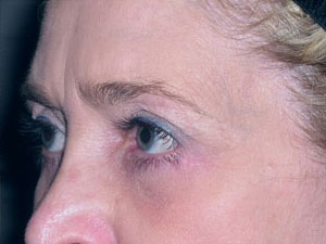 Eyelid Surgery Before and After Pictures Savannah, GA
