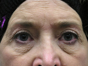 Eyelid Surgery Before and After Pictures Savannah, GA