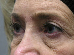 Eyelid Surgery Before and After Pictures Savannah, GA