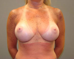 Breast Augmentation Before and After Pictures Savannah, GA