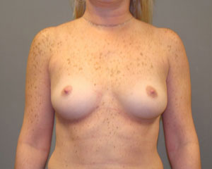 Breast Augmentation Before and After Pictures Savannah, GA