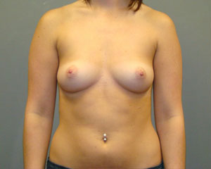 Breast Augmentation Before and After Pictures Savannah, GA