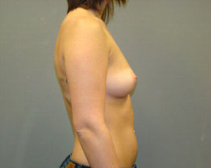 Breast Augmentation Before and After Pictures Savannah, GA