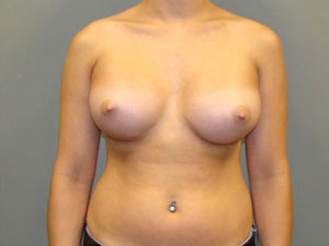 Breast Augmentation Before and After Pictures Savannah, GA