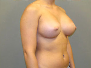 Breast Augmentation Before and After Pictures Savannah, GA