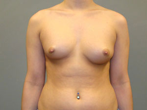 Breast Augmentation Before and After Pictures Savannah, GA