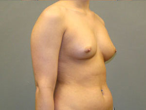 Breast Augmentation Before and After Pictures Savannah, GA