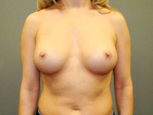 Breast Augmentation Before and After Pictures Savannah, GA