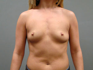 Breast Augmentation Before and After Pictures Savannah, GA