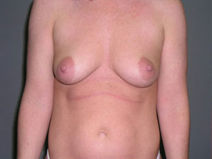 Breast Augmentation Before and After Pictures Savannah, GA