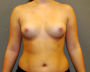 Breast Augmentation Before and After Pictures Savannah, GA