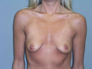 Breast Augmentation Before and After Pictures Savannah, GA