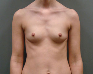Breast Augmentation Before and After Pictures Savannah, GA