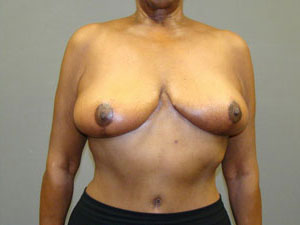 Breast Lift Before and After Pictures Savannah, GA