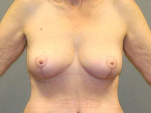 Breast Lift Before and After Pictures Savannah, GA
