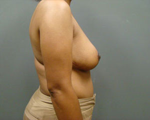 Breast Reduction Before and After Pictures Savannah, GA
