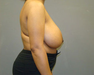 Breast Reduction Before and After Pictures Savannah, GA