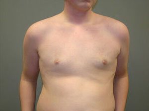 Breast Reduction Before and After Pictures Savannah, GA