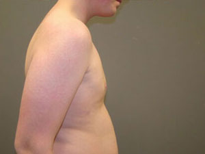 Breast Reduction Before and After Pictures Savannah, GA