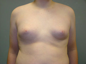Breast Reduction Before and After Pictures Savannah, GA
