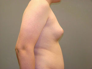 Breast Reduction Before and After Pictures Savannah, GA