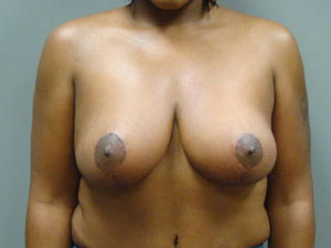 Breast Reduction Before and After Pictures Savannah, GA