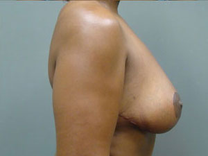Breast Reduction Before and After Pictures Savannah, GA