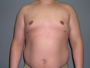 Breast Reduction Before and After Pictures Savannah, GA