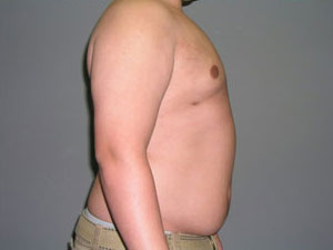Breast Reduction Before and After Pictures Savannah, GA