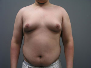 Breast Reduction Before and After Pictures Savannah, GA