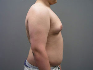 Breast Reduction Before and After Pictures Savannah, GA