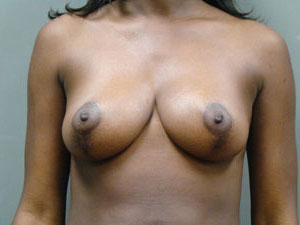 Breast Reduction Before and After Pictures Savannah, GA